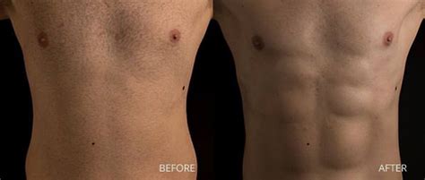 male liposuction miami|Miami male lipousction 